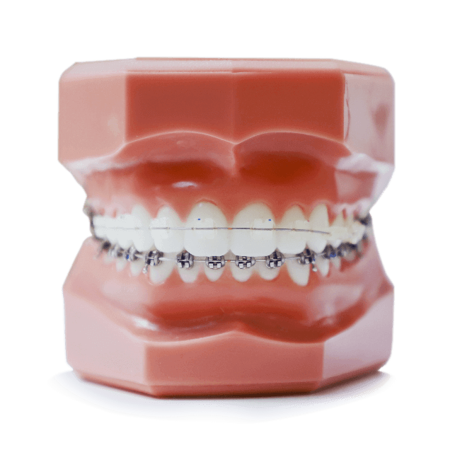Orthodontic Braces