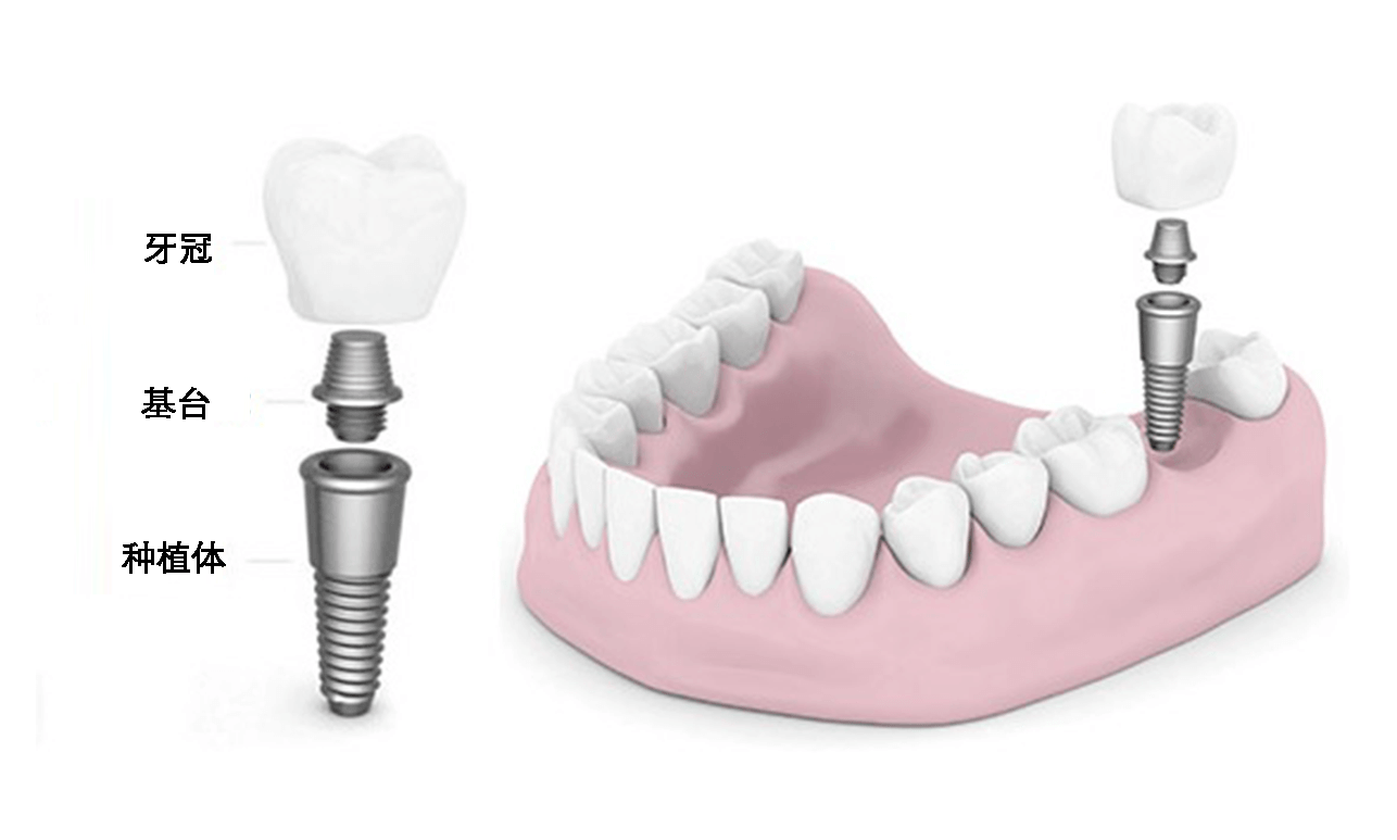 How do Dental Implants Work?
