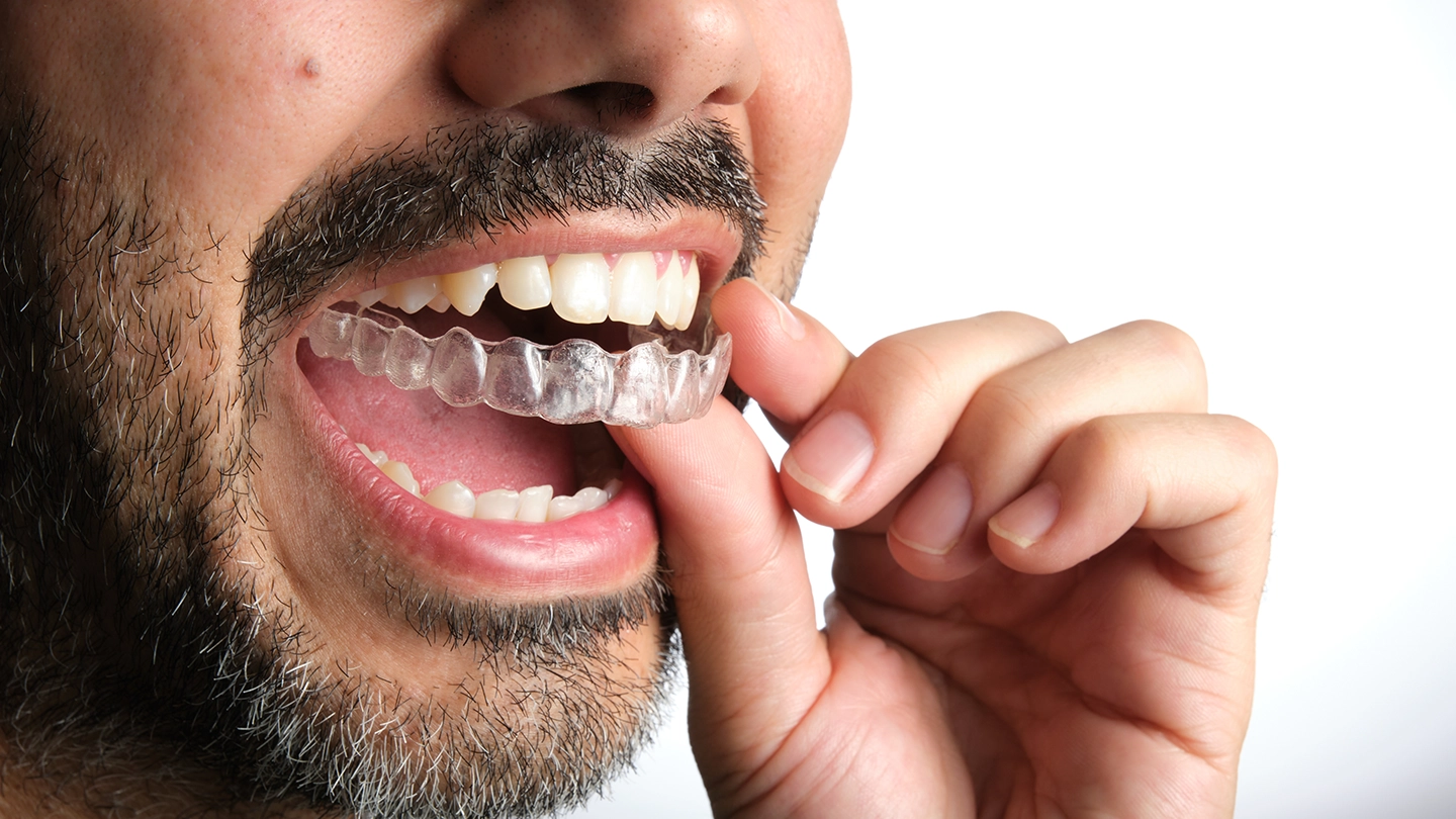 Man using clear aligners to fix malocclusion.