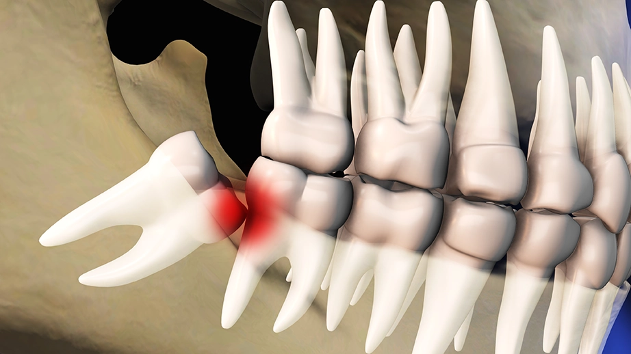 3D illustration of an impacted wisdom tooth.