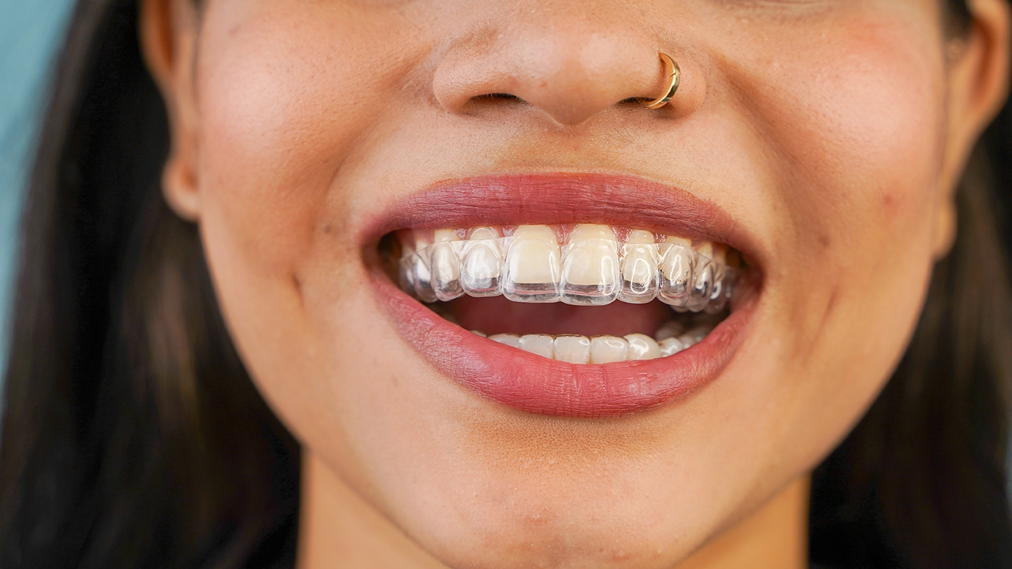 A woman undergoing Invisalign dental treatment