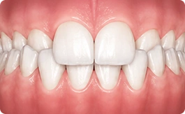 Crossbite