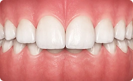 Overbite (Deep Bite)