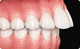 Overjet (Protrusion)
