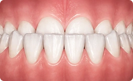 Underbite