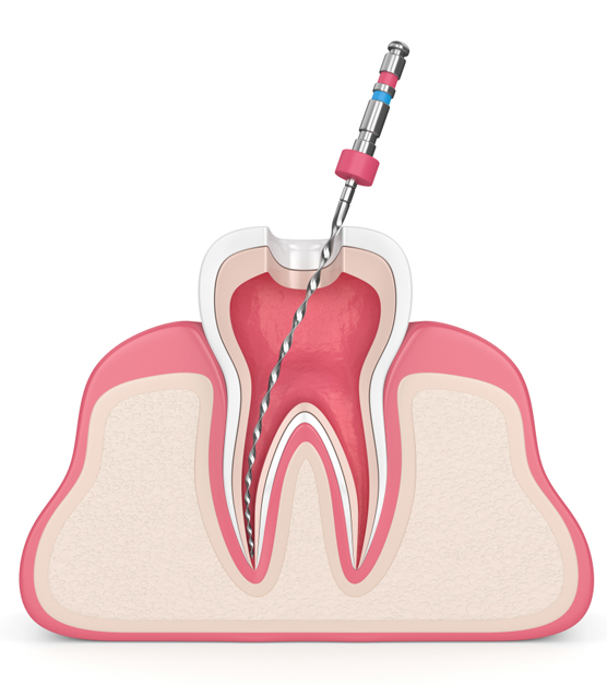 Endodontic Clinic Singapore Endodontist