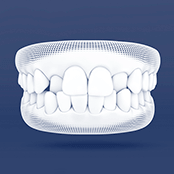 Cross Bite