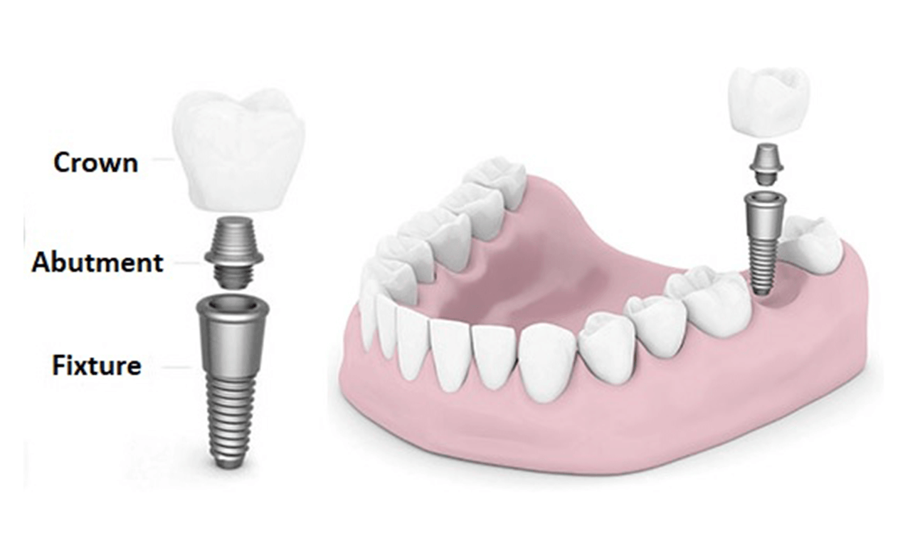 How do Dental Implants Work?