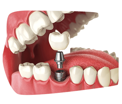 Picture of a Single Tooth Dental Implant
